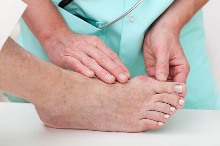 bunions-the-fresh-foot-centre